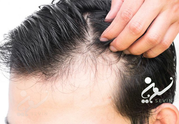 کاشت مو بلند در شقیقه‌